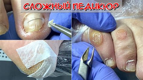 Альтернативные способы избавления от мозоли на мизинце