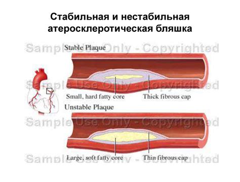 Артериосклероз и болезни сердца