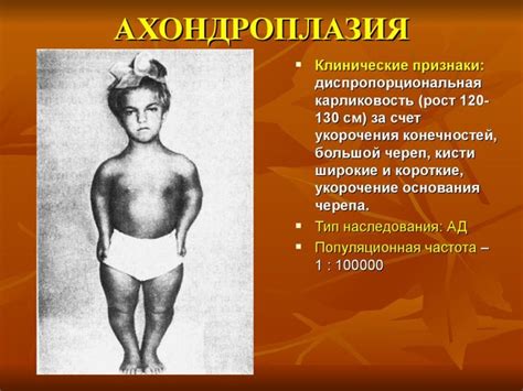 Ахондроплазия: признаки и диагностика
