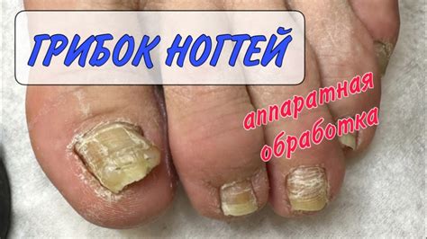 Баня для ногтей при грибке: важная информация