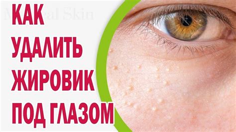 Безопасное удаление жировика на лице у ребенка дома