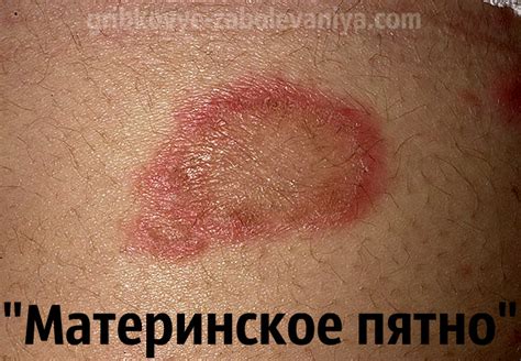 Важность раннего обнаружения материнской бляшки при лишае