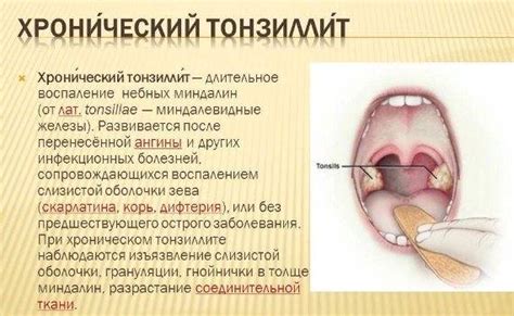 Важность своевременного лечения гноя на миндалинах у ребенка