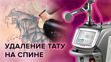 Важные моменты при удалении игольчатой татуировки самостоятельно