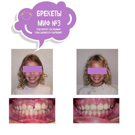 Важные факторы при выборе ставки брекетов для ребенка 8 лет