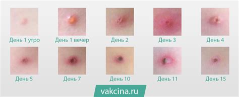 Ветрянка у взрослых: как вернуть свежий вид коже