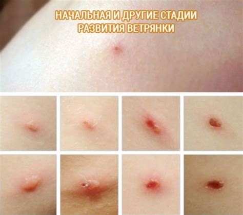 Ветрянка у ребенка: что это и как она проявляется