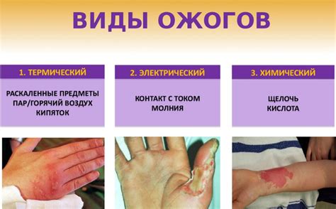 Виды ожогов и их последствия