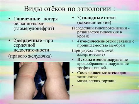 Виды отеков и их особенности