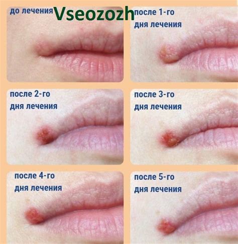 Влияние Радевита на состояние губ