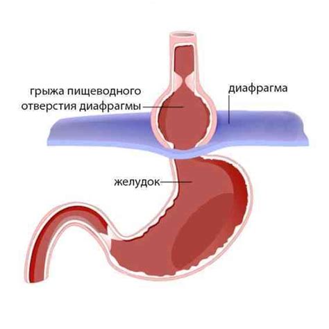 Влияние грыжи пищевода на пищеварительную систему