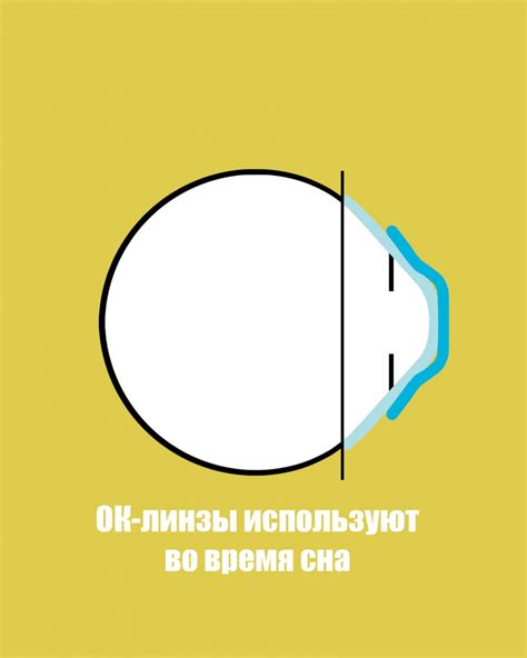 Влияние ночных линз на качество зрения
