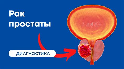 Влияние пищевых привычек на объем предстательной железы