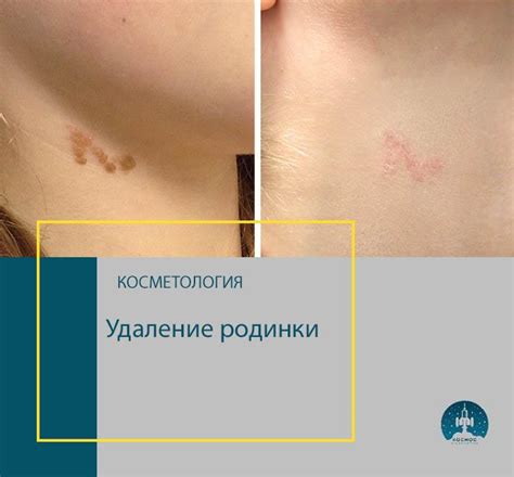 Влияние процедуры удаления родинки на образование шрама