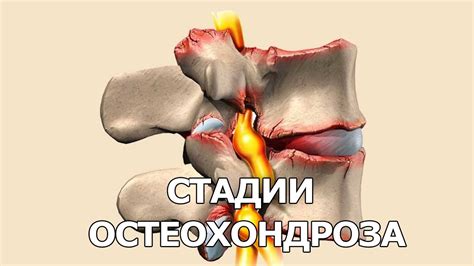 Возможность развития остеохондроза