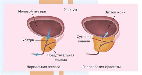 Возрастные изменения и увеличение предстательной железы