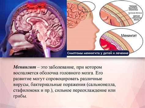 Воспаление головного мозга