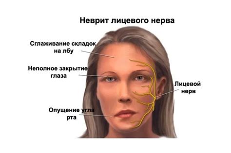 Воспаление лицевого нерва