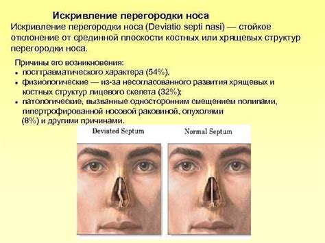 Генетические факторы в формировании носовой перегородки