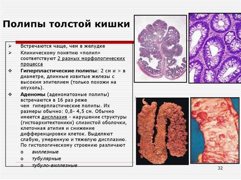 Гиперпластические полипы