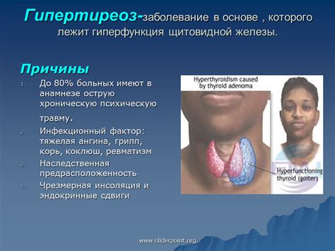 Гипертиреоз: причины давления от щитовидной железы