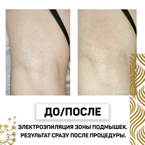 Глубокое удаление волос с помощью технологии электроэпиляции