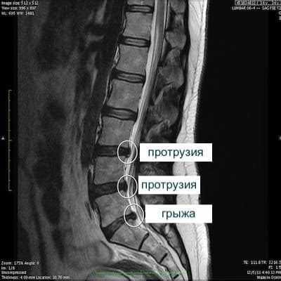 Грыжа поясничного крестцового отдела