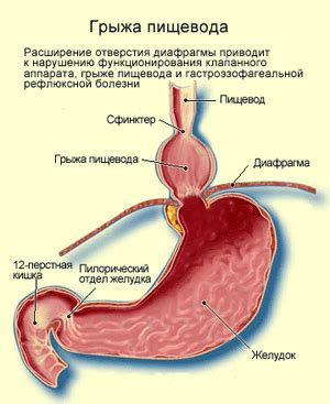 Диагностика грыжи пищевода