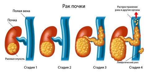 Диагностика и лечение породинок почек