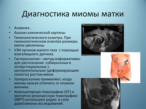 Диагностика миомы матки