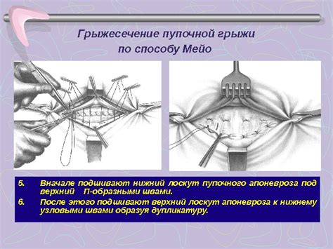 Диагностика пупочной грыжи