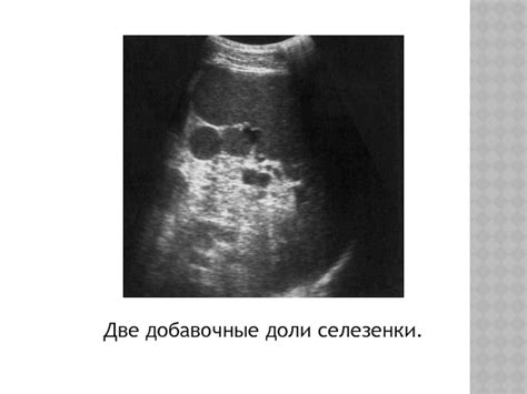 Диагностика увеличения селезенки