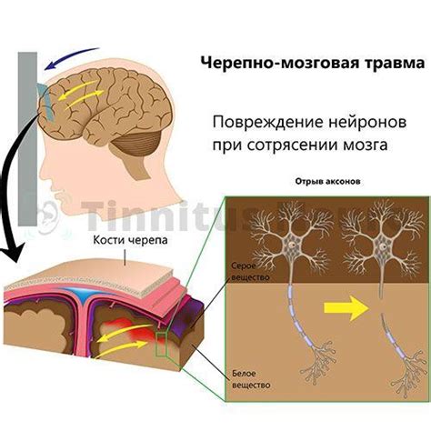 Домашние методы восстановления после сотрясения головы: что поможет быстрее