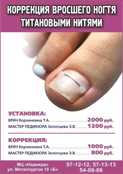 Домашние методы предотвращения врастания ногтя