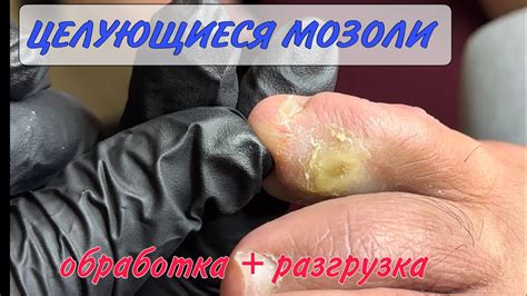 Домашние методы удаления мозолей на пальцах