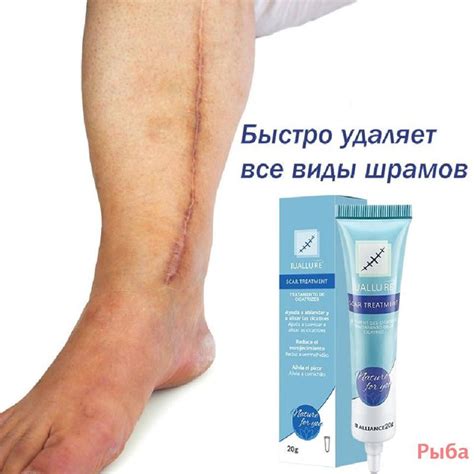 Домашние условия для быстрого устранения растяжек