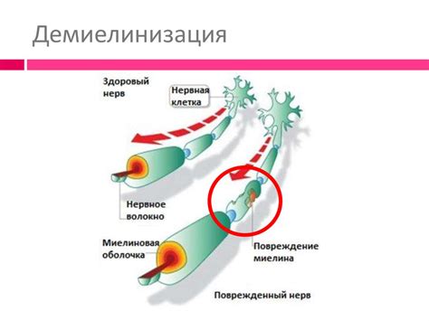 Достижения в области восстановления миелиновой оболочки нерва