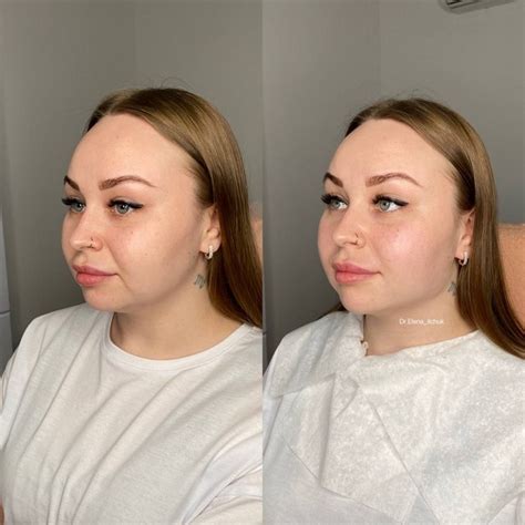 Естественные методы уменьшения объемных щек у бульдога
