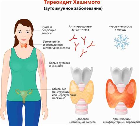 Естественные способы нормализации щитовидной железы