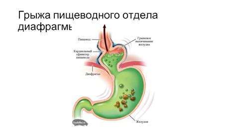 Желудочно-пищеводное рефлюксное заболевание