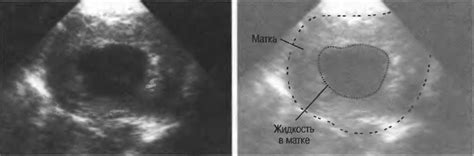 Жидкость за маткой: причины