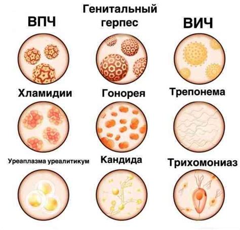Заболевания, вызывающие выделения