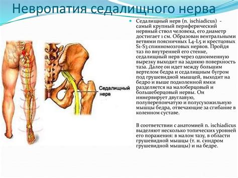 Защемление седалищного нерва: ловушка для нерва