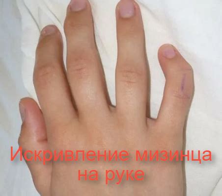 Здоровье рук: опасность выпрямления мизинца