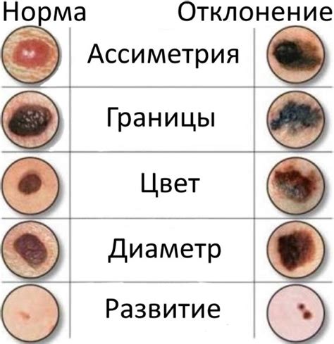 Значение родинки в жизни