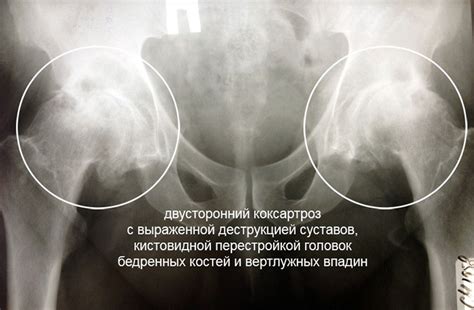 Значимость бедренного сустава для организма
