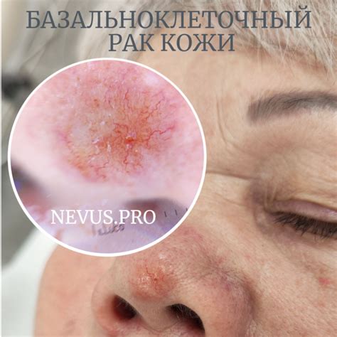 Идеальные методы распарки кожи на носу
