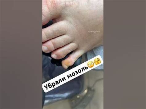 Избегание трения и давления на кожу ягодиц
