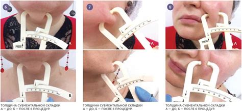 Измерение толщины складки кожи