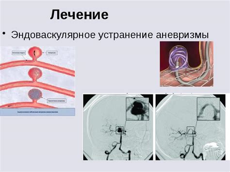Интраваскулярные методы диагностики аневризм мозга